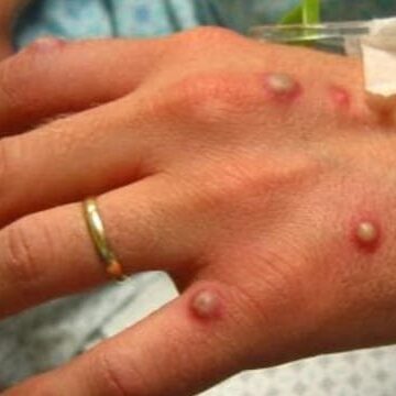 Monkeypox Declaration Coverage